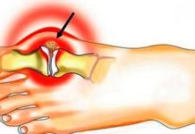 თუ პოდაგრა გაქვთ, ეს მეთოდები აუცილებლად უნდა სცადოთ