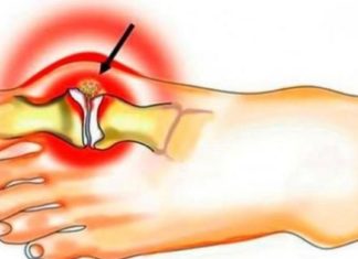 თუ პოდაგრა გაქვთ, ეს მეთოდები აუცილებლად უნდა სცადოთ