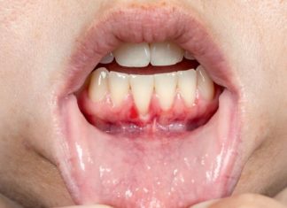 თუ ღრძილები დაგიზიანდათ, ტკივილს გრძნობთ და სისლი გდით, სცადეთ ეს შესანიშნავი მეთოდები და თავი დააღწიეთ ამ დისკომფორტს