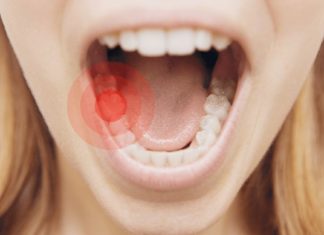თუ კბილები ხშირად გტკივდებათ უმჯობესია მცენარეული რეცეპტები გამოიყენოთ