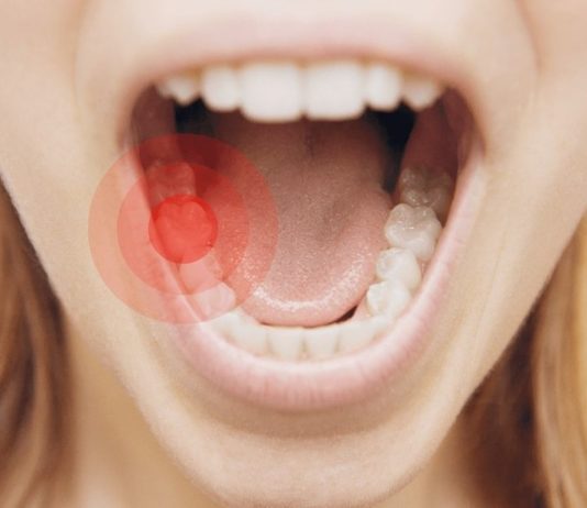 თუ კბილები ხშირად გტკივდებათ უმჯობესია მცენარეული რეცეპტები გამოიყენოთ