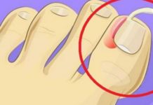 ფრჩხილის ჩაბრუნება საშინელი პროცესია, თუმცა ნუ დამწუხრდებით, დღეს გასწავლით ყველაზე ეფექტურ მეთოდებს