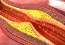 იცით, რა უნდა მოიმოქმედოთ, იმისათვის რომ სიბერეში ათეროსკლეროზმა არ შემოგიტიოთ ?!