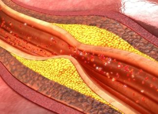 იცით, რა უნდა მოიმოქმედოთ, იმისათვის რომ სიბერეში ათეროსკლეროზმა არ შემოგიტიოთ ?!