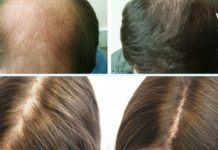 თუ თმა გცვივათ და არ იცით როგორ შეაჩეროთ ეს პროცესი, გასწავლით საოცარ მეთოდს.