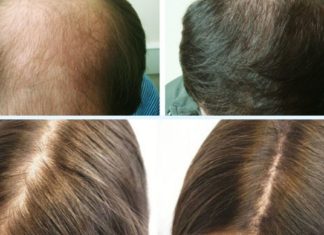 თუ თმა გცვივათ და არ იცით როგორ შეაჩეროთ ეს პროცესი, გასწავლით საოცარ მეთოდს.