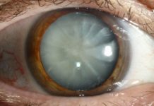 კატარაქტას შეჩერება ამ გზით ყველაზე მარტივია