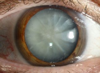 კატარაქტას შეჩერება ამ გზით ყველაზე მარტივია