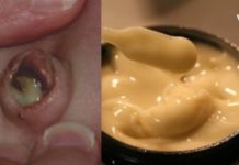 ამ მალამოს ორგანიზმიდან გამოაქვს ჩირქი. მისი მომზადება საკმაოდ მარტივია