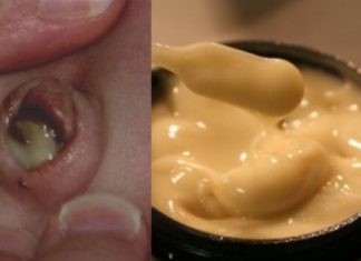 ამ მალამოს ორგანიზმიდან გამოაქვს ჩირქი. მისი მომზადება საკმაოდ მარტივია