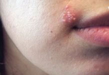 თუ ტუჩის ჰერპესი გაქვთ და არ იცით როგორ გაუმკლავდეთ, გასწავლით სწრაფ და ეფექტურ მეთოდებს