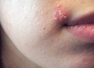 თუ ტუჩის ჰერპესი გაქვთ და არ იცით როგორ გაუმკლავდეთ, გასწავლით სწრაფ და ეფექტურ მეთოდებს