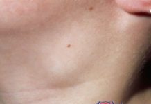 მას შემდეგ რაც 50 წელს გადავაბიჯე ადენომასთან შებრძოლება მომიწია. ხალხური რეცეპტით შევუდექი მკურნალობას და ადენომამ ზრდა შეწყვიტა.