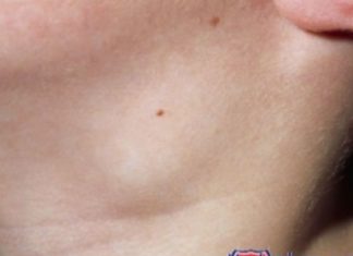 მას შემდეგ რაც 50 წელს გადავაბიჯე ადენომასთან შებრძოლება მომიწია. ხალხური რეცეპტით შევუდექი მკურნალობას და ადენომამ ზრდა შეწყვიტა.