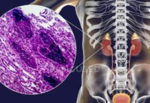 პიელონეფრიტის დროს მოამზადეთ ეს განმაცვიფრებელი ნაყენი და შედეგით გაოცდებით