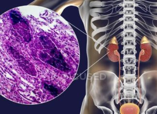 პიელონეფრიტის დროს მოამზადეთ ეს განმაცვიფრებელი ნაყენი და შედეგით გაოცდებით