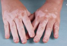 ვიტილიგოს მკურნალობა ამ მეთოდებით ბევრად მარტივია