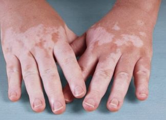 ვიტილიგოს მკურნალობა ამ მეთოდებით ბევრად მარტივია