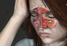 გამოიყენეთ ეს რეცეპტები და ჰაიმორიტი აღარ შეგაწუხებთ