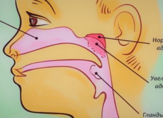 შოკისმომგვრელი რეცეპტი : ადენოიდების მკურნალობა სახლში უკვე გამარტივდა