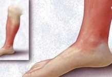 საუკეთესო რეცეპტი წითელი ქარის სამკურნალოდ