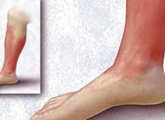 საუკეთესო რეცეპტი წითელი ქარის სამკურნალოდ