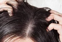 Როგორ მოვიშოროთ ქერტლი სახლის პირობებში სწრაფად და მარტივად