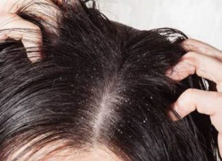 Როგორ მოვიშოროთ ქერტლი სახლის პირობებში სწრაფად და მარტივად