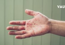 Როგორ დავიცვათ თავი კოკსაკის ვირუსისგან ? – პრევენციული მეთოდები