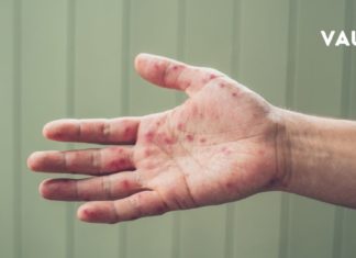 Როგორ დავიცვათ თავი კოკსაკის ვირუსისგან ? – პრევენციული მეთოდები