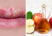 ჰერპესის სამკურნალოდ გამოცდილი ბუნებრივი საშუალებები , 100%-იანი შედეგი აქვს.