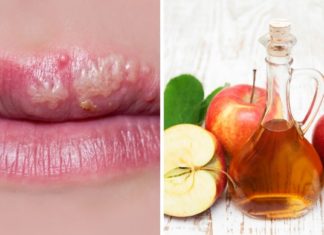 ჰერპესის სამკურნალოდ გამოცდილი ბუნებრივი საშუალებები , 100%-იანი შედეგი აქვს.