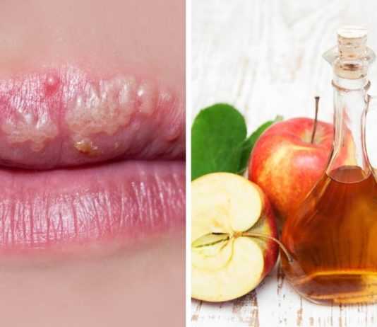 ჰერპესის სამკურნალოდ გამოცდილი ბუნებრივი საშუალებები , 100%-იანი შედეგი აქვს.