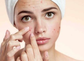 6 ფაქტი აკნეს შესახებ: როგორ იზრუნოთ თქვენს კანზე