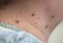 მოშორეთ კაპილარების პრობლემა, დაუბრუნეთ კანს სილამაზე საოცარი ბალზამით-ეფექტურია!