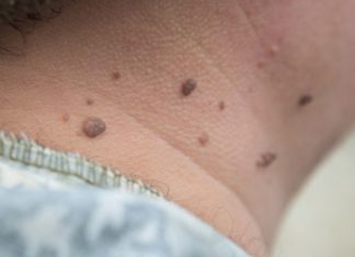 მოშორეთ კაპილარების პრობლემა, დაუბრუნეთ კანს სილამაზე საოცარი ბალზამით-ეფექტურია!