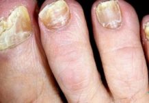 “ამ რეცეპტის დახმარებით ფრჩხილის სოკო სამუდამოდ გავიქრე” – ეს უნდა იცოდეთ.