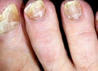 “ამ რეცეპტის დახმარებით ფრჩხილის სოკო სამუდამოდ გავიქრე” – ეს უნდა იცოდეთ.