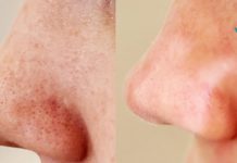 სასწაულებს ახდენს! როგორ მოვიშოროთ შავი წერტილები ცხვირსა და სახეზე – ინდური საიდუმლო!