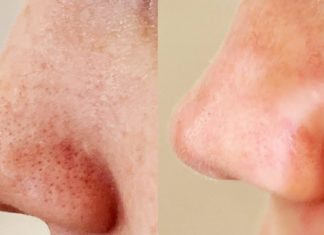 სასწაულებს ახდენს! როგორ მოვიშოროთ შავი წერტილები ცხვირსა და სახეზე – ინდური საიდუმლო!