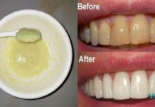ეს მეთოდი ბევრს გამოადგა!! თუ გსურთ ჯანსაღი კბილები, მაშინ გამოიყენეთ ეს ნარევი პირის ღრუს სავლებად!!! ეს მეთოდი ბევრს გამოადგა… ლიმონი და სოდა