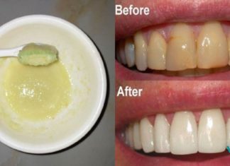 ეს მეთოდი ბევრს გამოადგა!! თუ გსურთ ჯანსაღი კბილები, მაშინ გამოიყენეთ ეს ნარევი პირის ღრუს სავლებად!!! ეს მეთოდი ბევრს გამოადგა… ლიმონი და სოდა