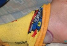 ჩაიდეთ დაჭრილი ხახვი ნასკების ქვეშ და სამუდამოდ დაემშვიდობეთ ფეხის სოკოს!