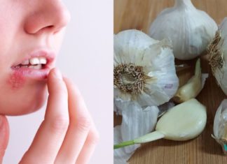“არ მეგონა თუ ჰერპესს ერთ დღეში გავიქრობდი”! ეს რეცეპტი ყველამ უნდა სცადოთ!