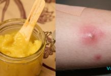 ეს არის უებარი წამალი ძირმაგარას სამკურნალოდ, რომელიც ნამდვილად მოგგვრით შვებას! ძირმაგარა