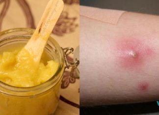 ეს არის უებარი წამალი ძირმაგარას სამკურნალოდ, რომელიც ნამდვილად მოგგვრით შვებას! ძირმაგარა