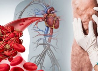 “ამ პროდუქტებმა ჩემი სიცოცხლე გადაარჩინეს”! ნახეთ რეცეპტი, რომელიც თრომბის საშიშროებას თავიდან აგარიდებთ!