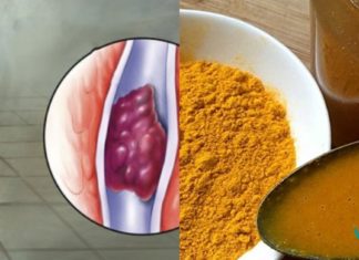 თუ გაწუხებთ თრომბი მაშინ ეს რეცეპტი თქვენთვისაა! – პირდაპირ მკურნალის წიგნაკიდან