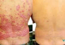 ექიმები ამას არასოდეს გეტყვიან: აი, როგორ უნდა ვუმკურნალოთ კანის ამ დაავადებას!