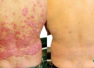 ექიმები ამას არასოდეს გეტყვიან: აი, როგორ უნდა ვუმკურნალოთ კანის ამ დაავადებას!